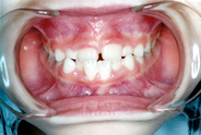 混合歯列治療前例