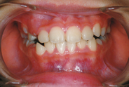 混合歯列治療前例